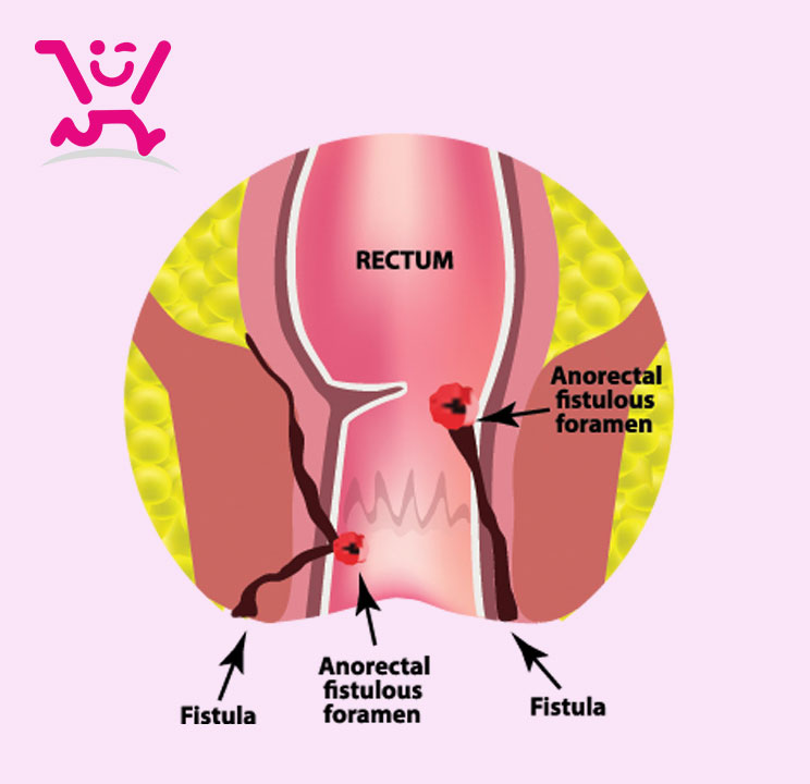 زخم مقعد (شقاق یا فیشر) چیست؟ 1 زخم مقعد (شقاق یا فشر) Anal Fissure